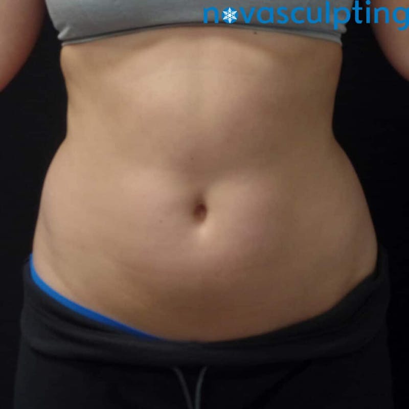 Abdomen Before & After Gallery - Patient 133024854 - Image 1