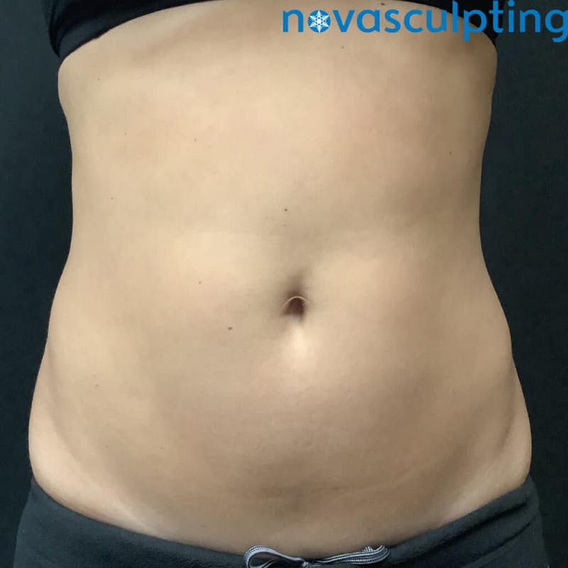 Abdomen Before & After Gallery - Patient 133024854 - Image 2