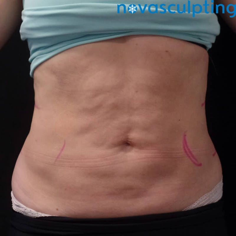 Abdomen Before & After Gallery - Patient 133024857 - Image 1