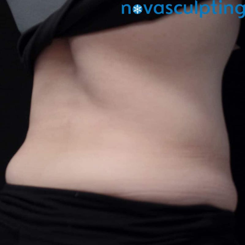 Upper & Lower Back Before & After Gallery - Patient 133024856 - Image 1