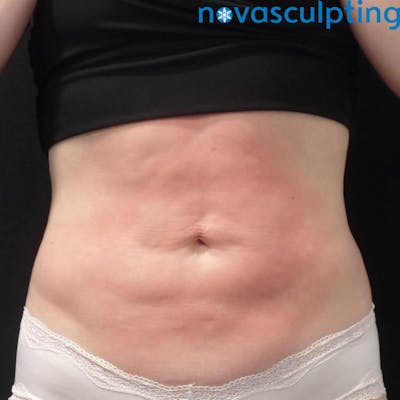 Abdomen Before & After Gallery - Patient 133024857 - Image 2