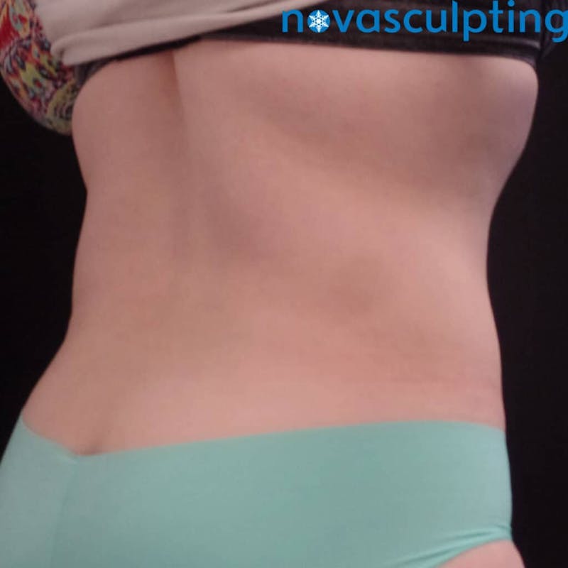 Upper & Lower Back Before & After Gallery - Patient 133024856 - Image 2