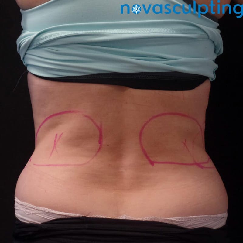 Upper & Lower Back Before & After Gallery - Patient 133024858 - Image 1