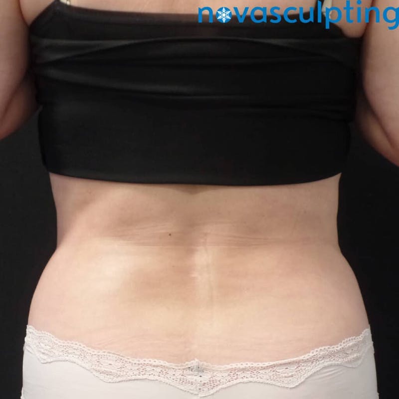 Abdomen Before & After Gallery - Patient 133024857 - Image 4