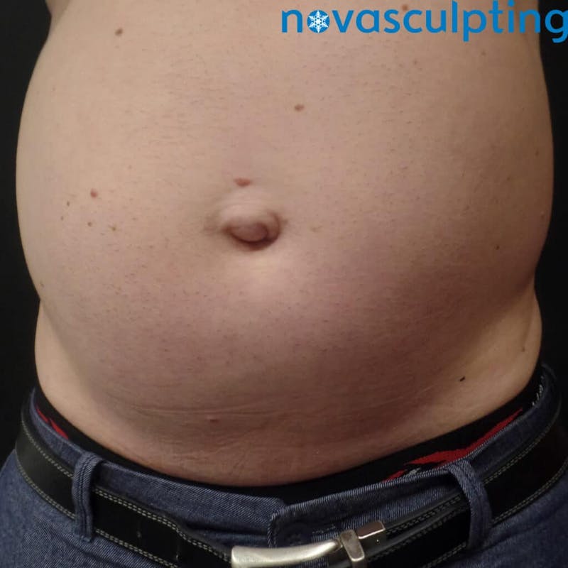 Abdomen Before & After Gallery - Patient 133024859 - Image 1