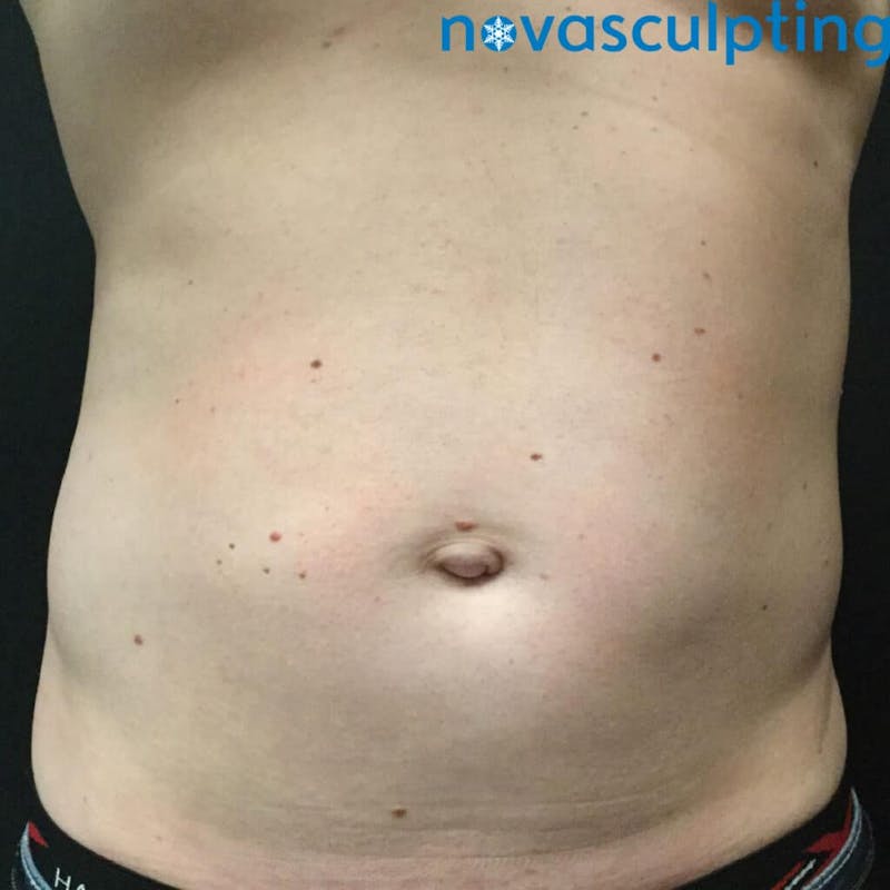 Abdomen Before & After Gallery - Patient 133024859 - Image 2