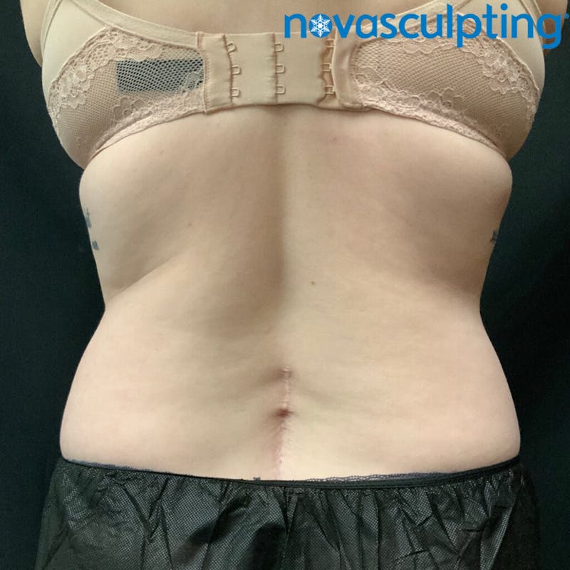 Upper & Lower Back Before & After Gallery - Patient 133024860 - Image 1