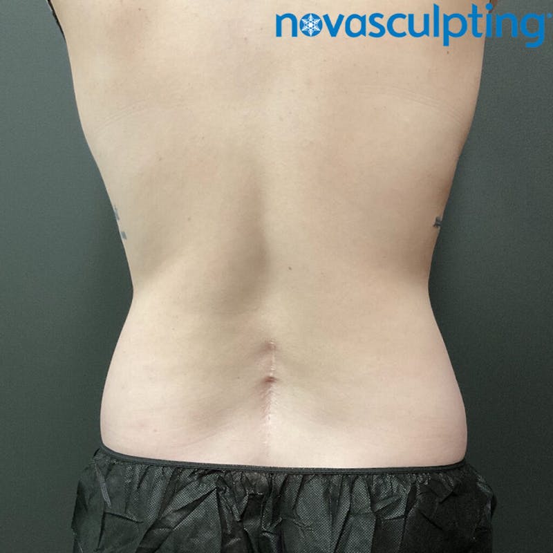 Upper & Lower Back Before & After Gallery - Patient 133024860 - Image 2