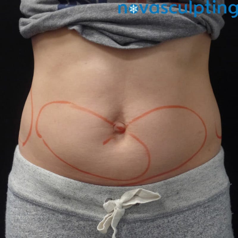 Abdomen Before & After Gallery - Patient 133024863 - Image 1