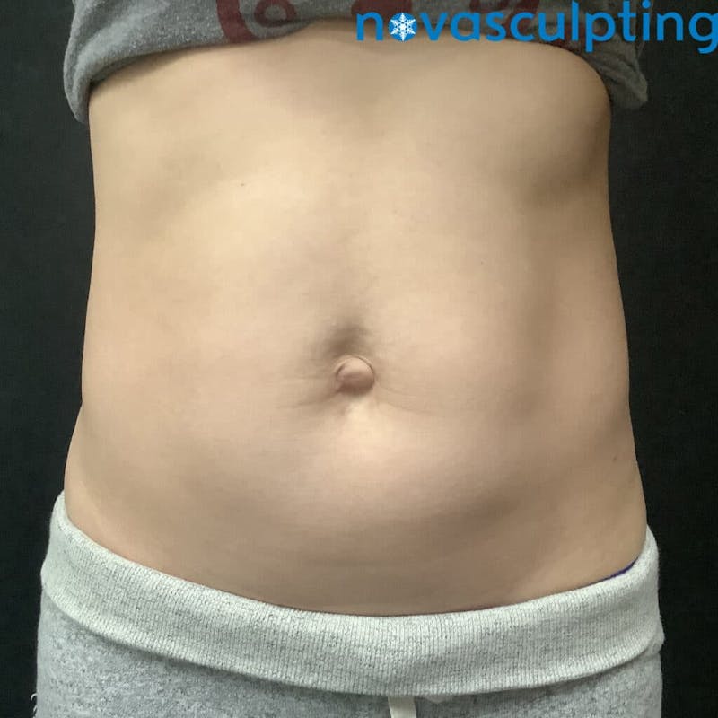 Abdomen Before & After Gallery - Patient 133024863 - Image 2