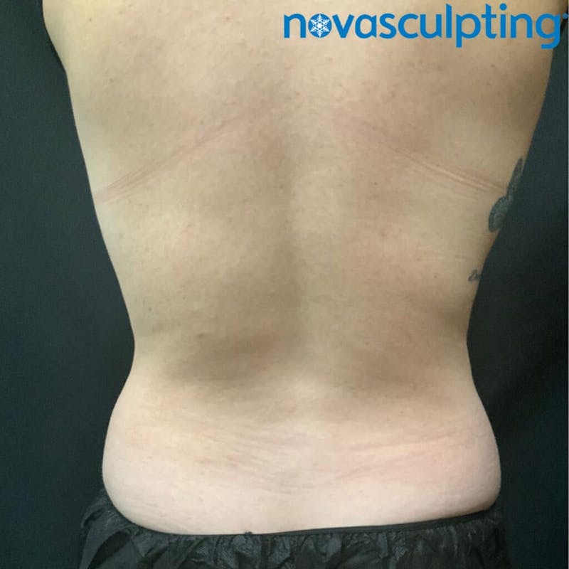 Upper & Lower Back Before & After Gallery - Patient 133024864 - Image 1