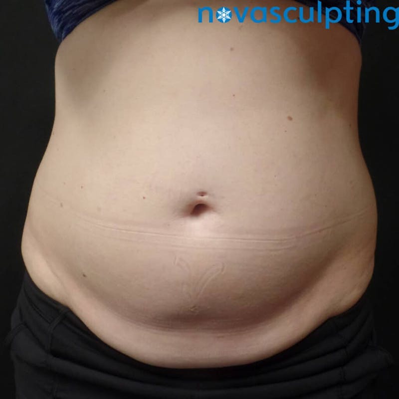 Abdomen Before & After Gallery - Patient 133024867 - Image 1