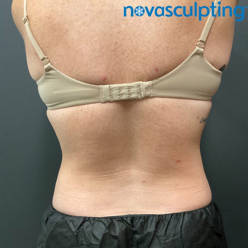 Upper & Lower Back Before & After Gallery - Patient 133024864 - Image 2