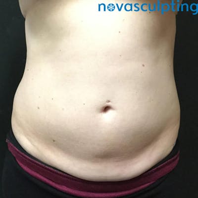 Abdomen Before & After Gallery - Patient 133024867 - Image 2