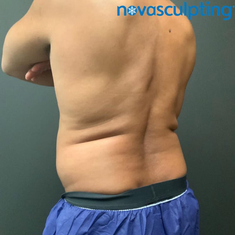 Upper & Lower Back Before & After Gallery - Patient 133024866 - Image 1