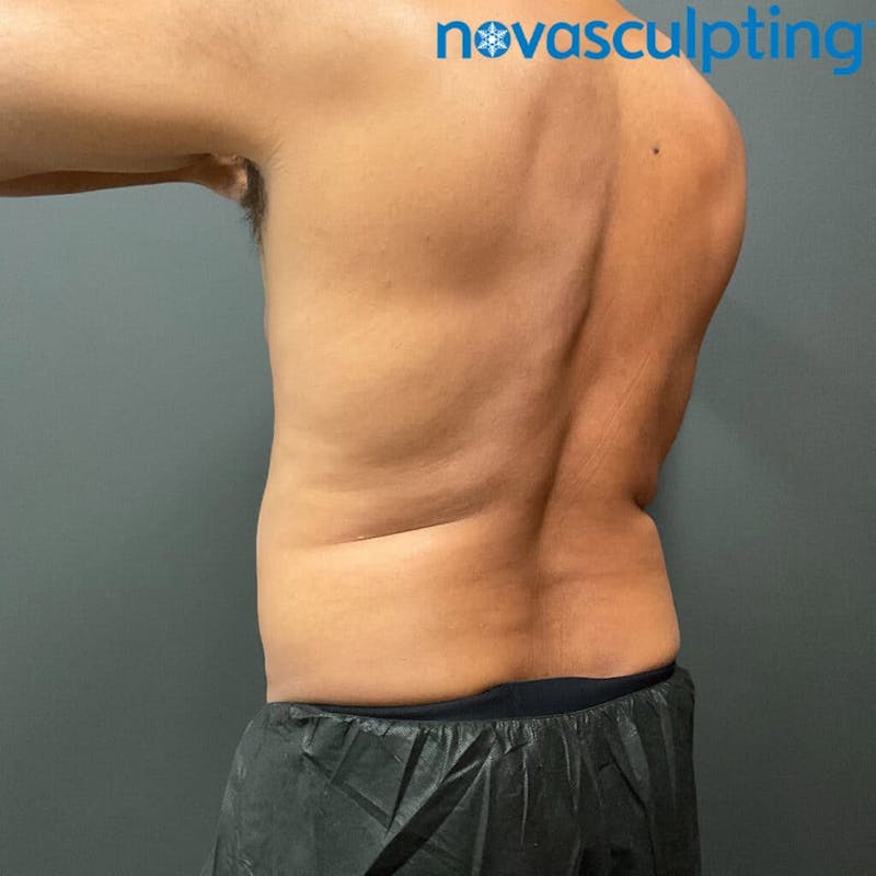 Upper & Lower Back Before & After Gallery - Patient 133024866 - Image 2