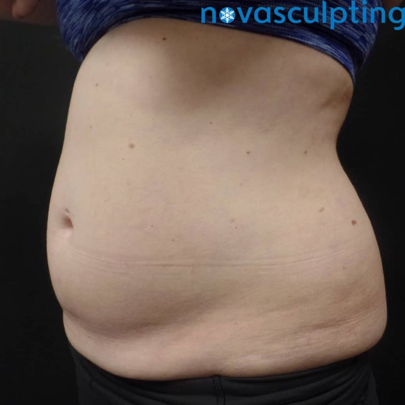 Abdomen Before & After Gallery - Patient 133024867 - Image 5