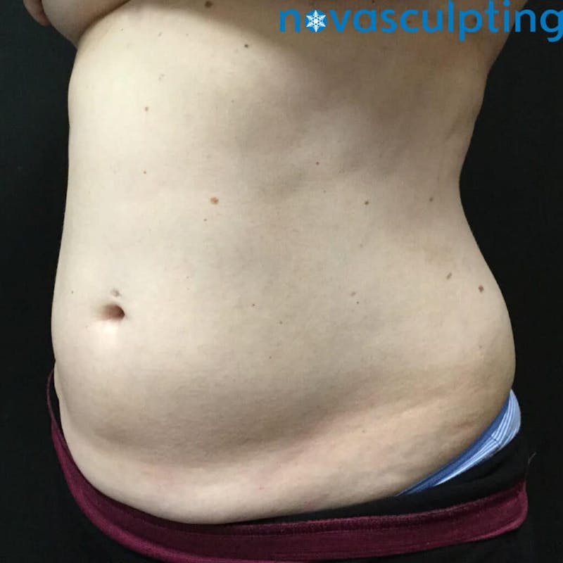 Abdomen Before & After Gallery - Patient 133024867 - Image 6