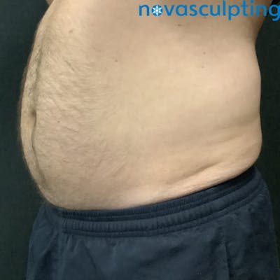 Abdomen Before & After Gallery - Patient 133024869 - Image 1