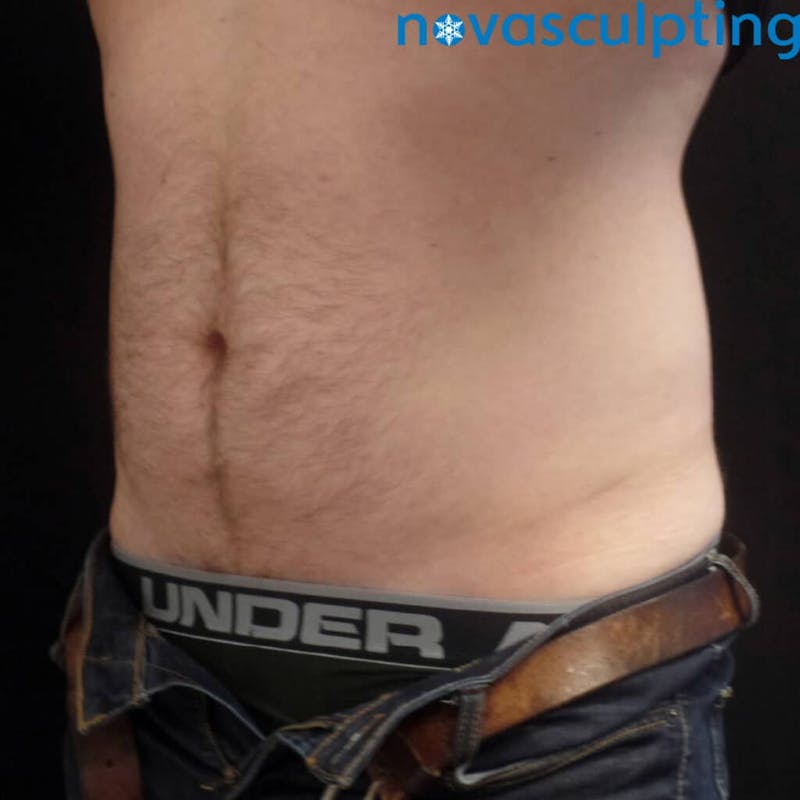 Abdomen Before & After Gallery - Patient 133024869 - Image 2