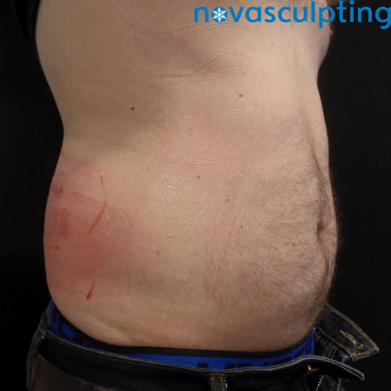 Abdomen Before & After Gallery - Patient 133024869 - Image 3