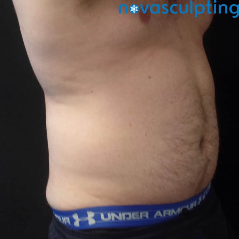 Abdomen Before & After Gallery - Patient 133024869 - Image 4