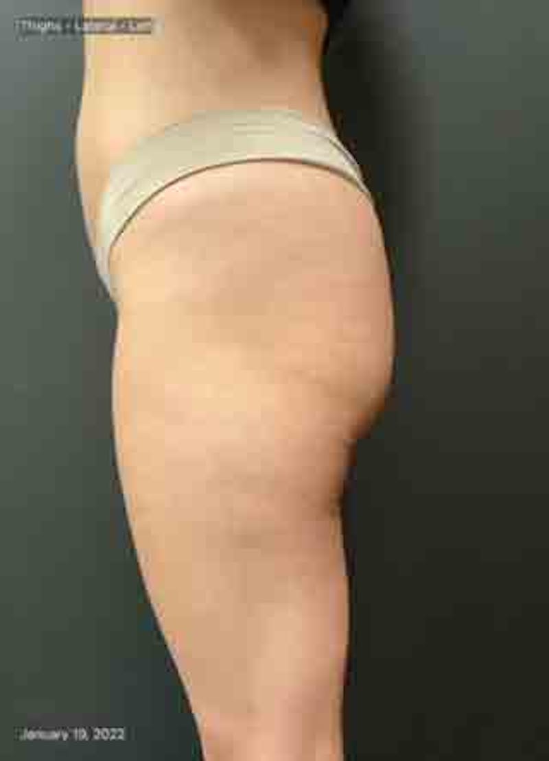 Glutes Before & After Gallery - Patient 133024928 - Image 5