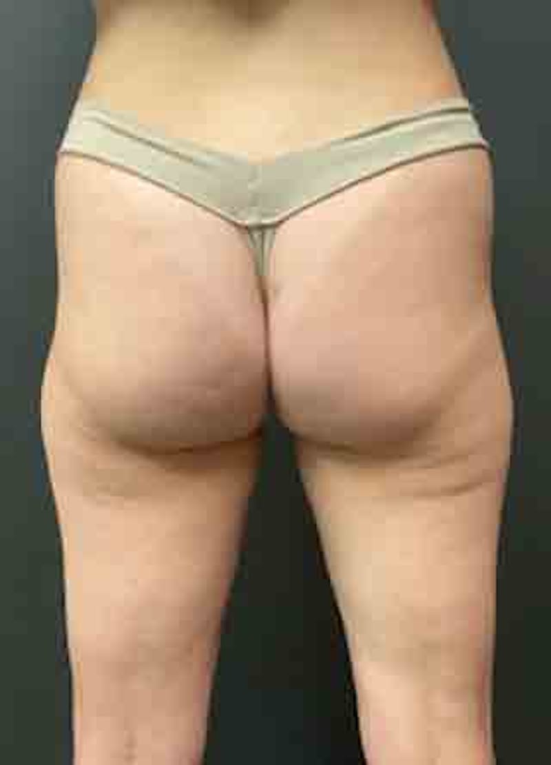 Glutes Before & After Gallery - Patient 133024928 - Image 1