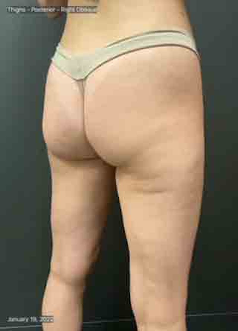 Glutes Before & After Gallery - Patient 133024928 - Image 7