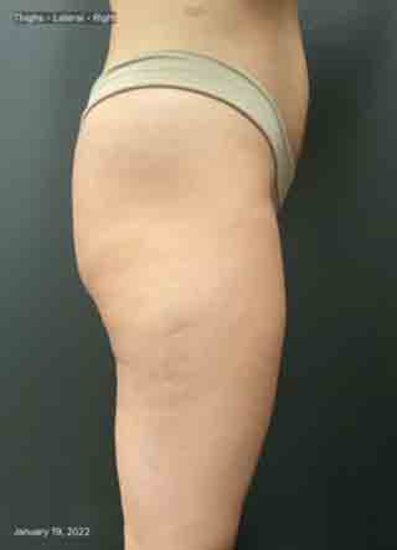 Glutes Before & After Gallery - Patient 133024928 - Image 9