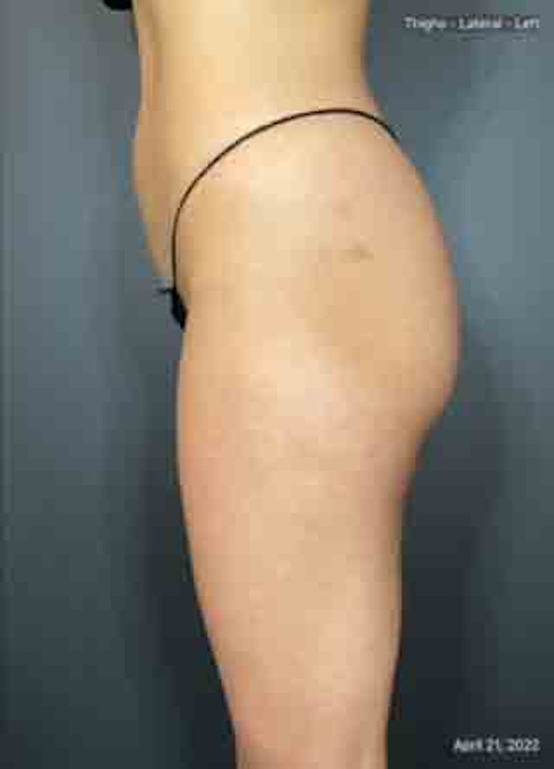 Glutes Before & After Gallery - Patient 133024928 - Image 6
