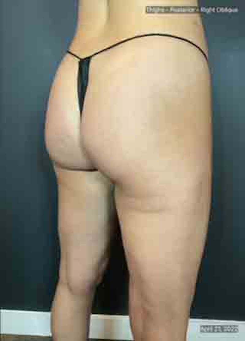 Glutes Before & After Gallery - Patient 133024928 - Image 8