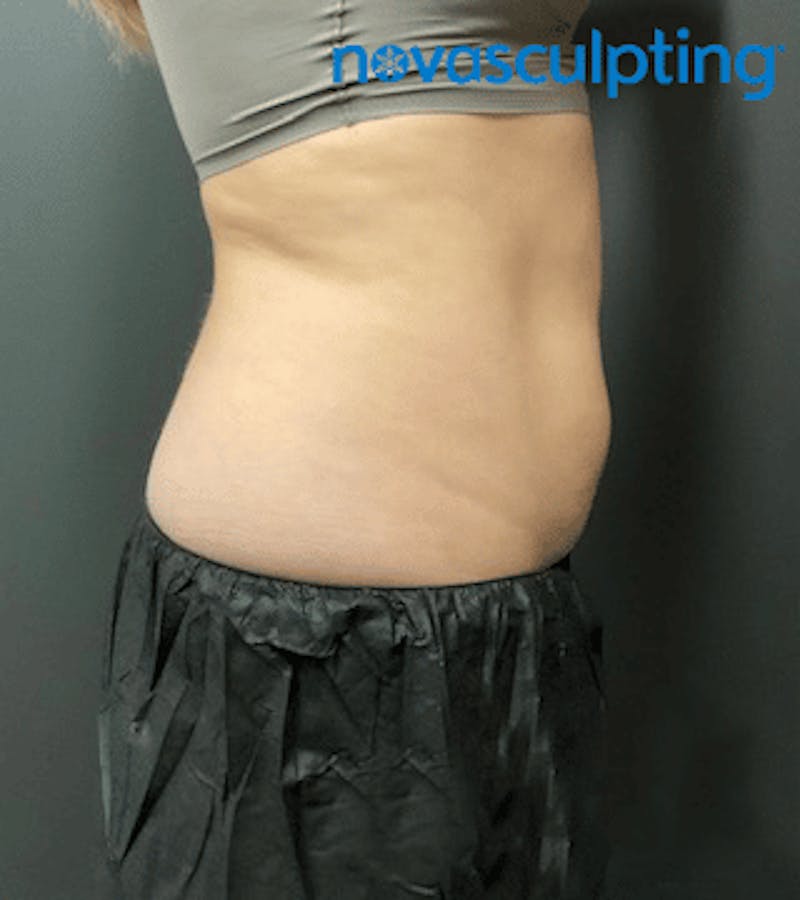 Back & Bra Fat Before & After Gallery - Patient 133024931 - Image 3
