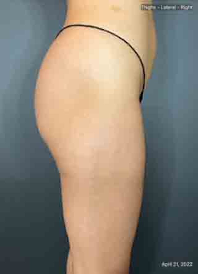 Glutes Before & After Gallery - Patient 133024928 - Image 10