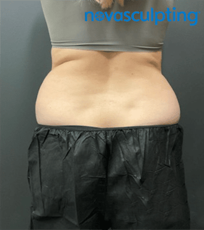 Back & Bra Fat Before & After Gallery - Patient 133024931 - Image 1