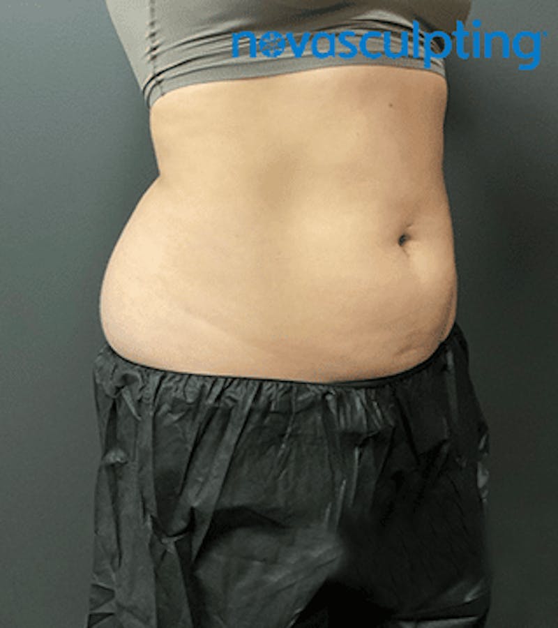 Back & Bra Fat Before & After Gallery - Patient 133024931 - Image 5