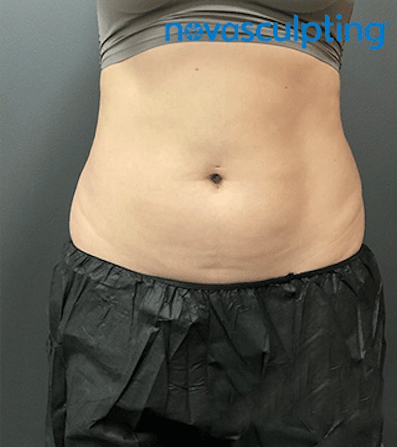 Bra Fat