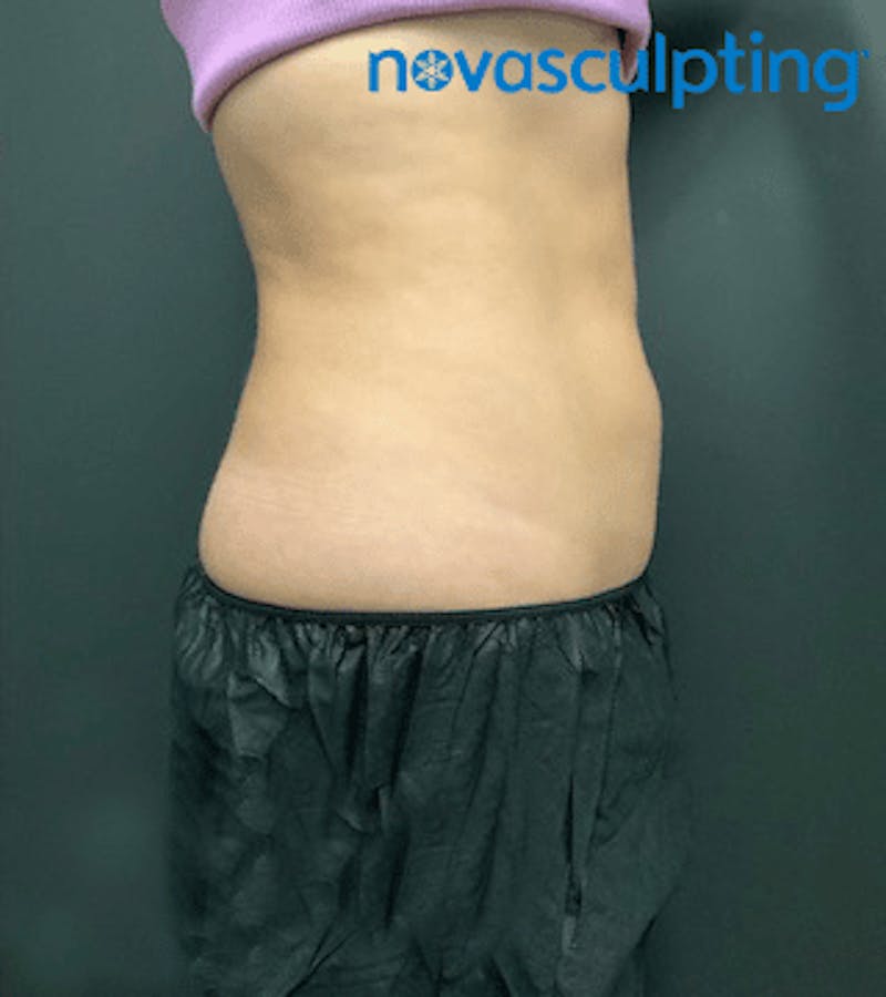 Back & Bra Fat Before & After Gallery - Patient 133024931 - Image 4
