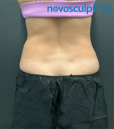 Back & Bra Fat Before & After Gallery - Patient 133024931 - Image 2