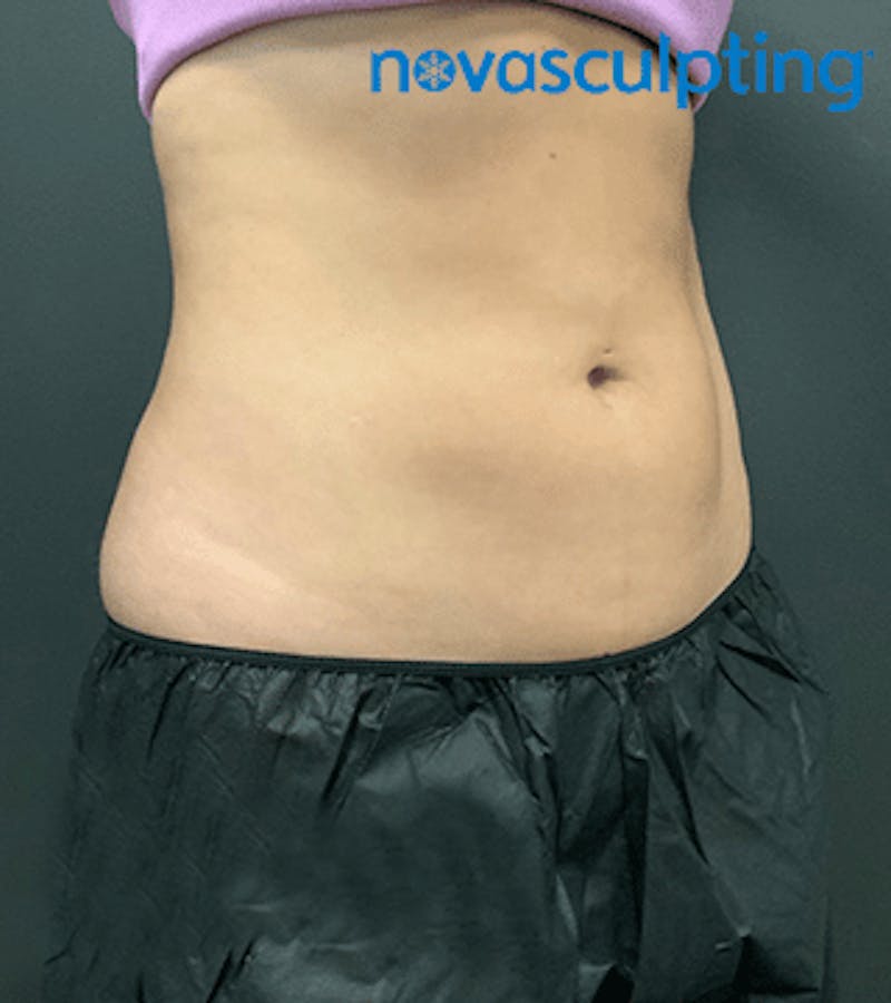 Back & Bra Fat Before & After Gallery - Patient 133024931 - Image 6