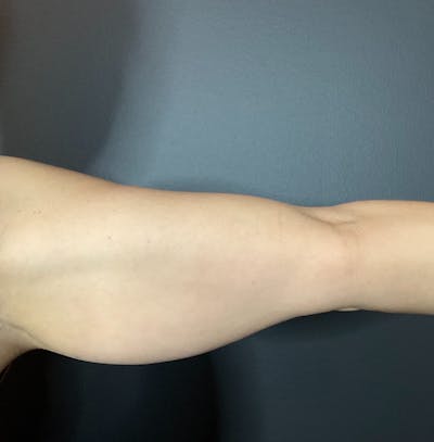 Arms Before & After Gallery - Patient 133191336 - Image 1