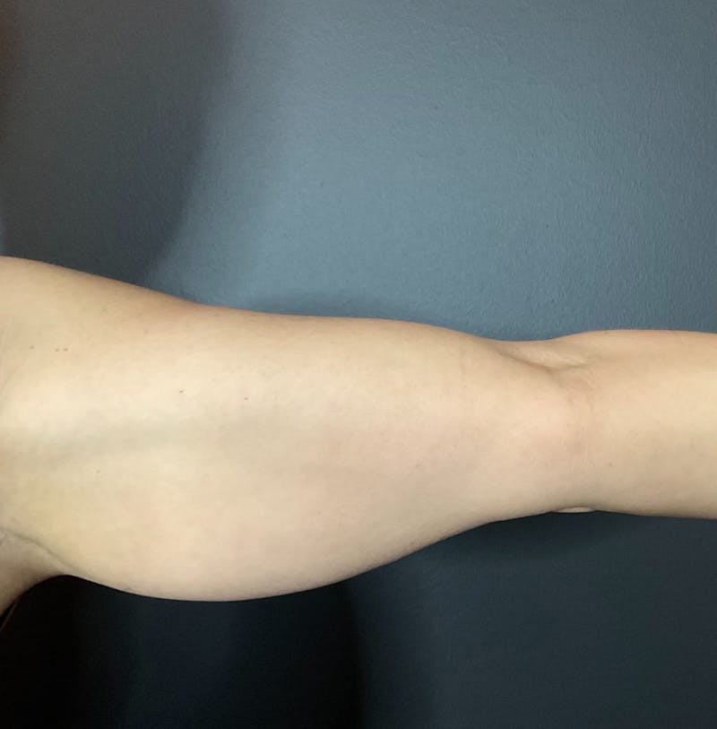 Arms Before & After Gallery - Patient 133191336 - Image 1