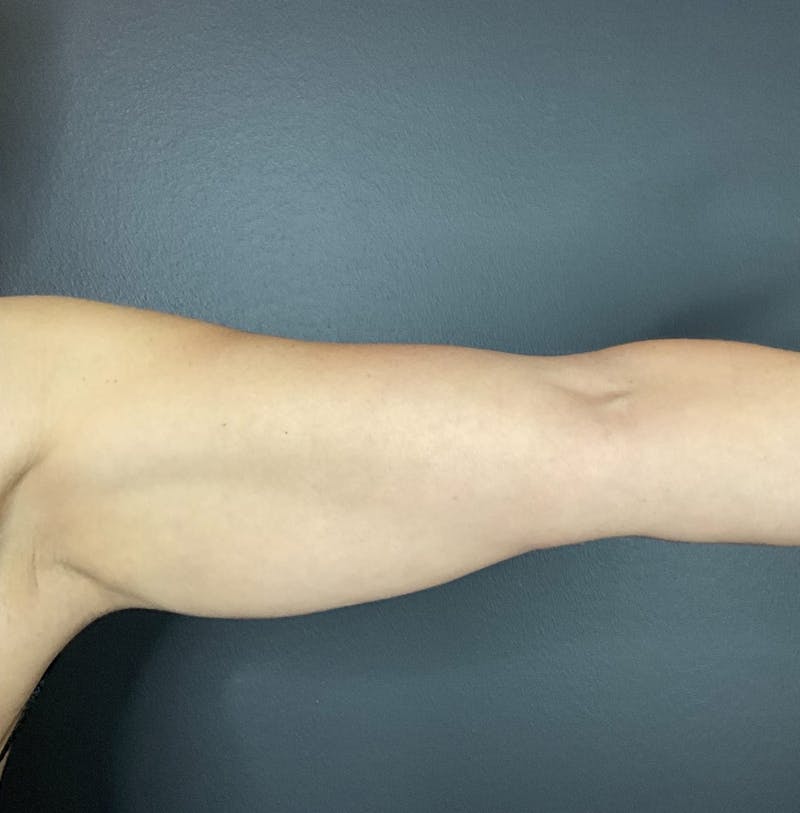 Arms Before & After Gallery - Patient 133191336 - Image 2