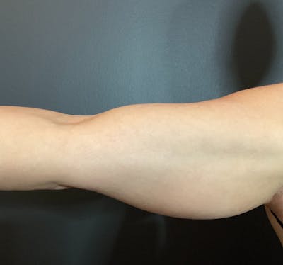 Arms Before & After Gallery - Patient 133191337 - Image 1