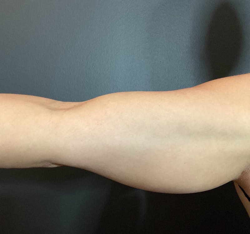 Arms Before & After Gallery - Patient 133191337 - Image 1
