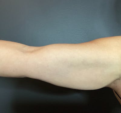 Arms Before & After Gallery - Patient 133191337 - Image 2
