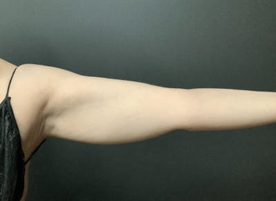 Arms Before & After Gallery - Patient 133191338 - Image 1