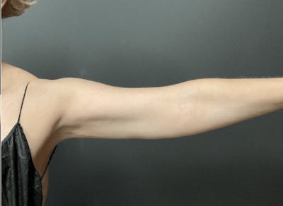 Arms Before & After Gallery - Patient 133191338 - Image 2