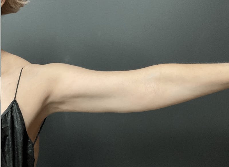 Arms Before & After Gallery - Patient 133191338 - Image 2