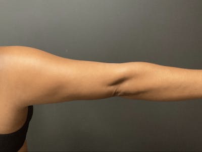 Arms Before & After Gallery - Patient 133191339 - Image 2